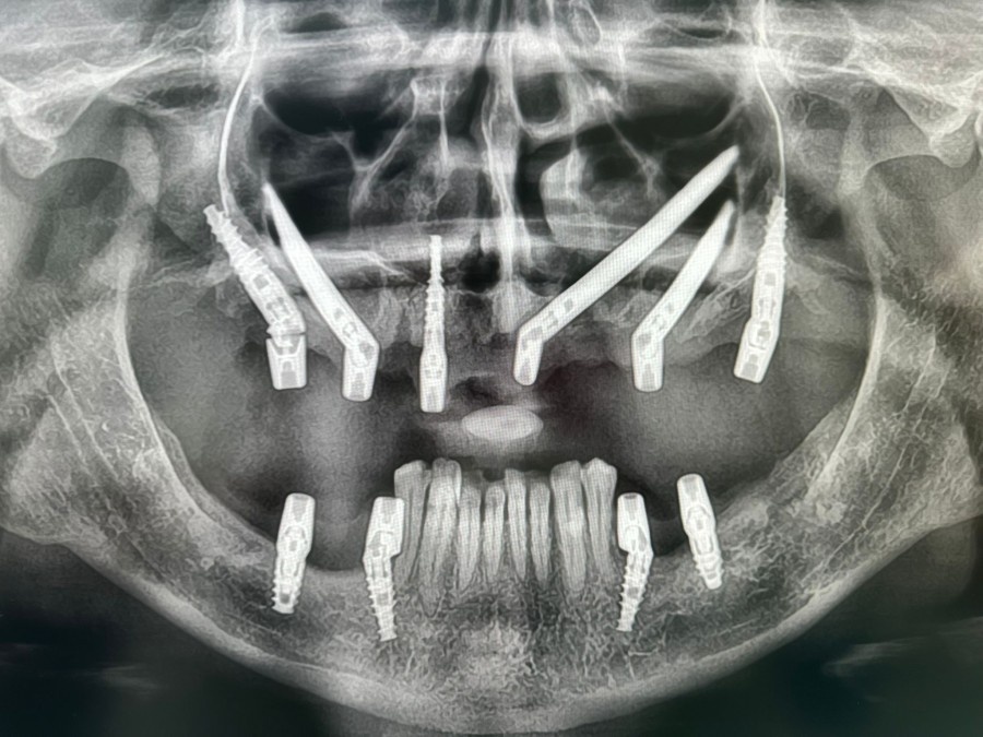 Impianti Zigomatici per Anziani